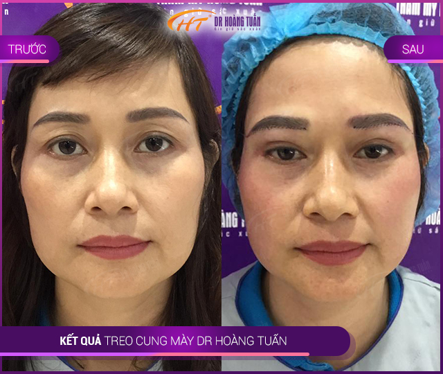 Kết quả chỉnh sửa chân mày tại Thẩm mỹ Hoàng Tuấn